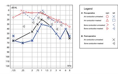 Case Report: Fremitus Nystagmus in Superior Canal Dehiscence Syndrome